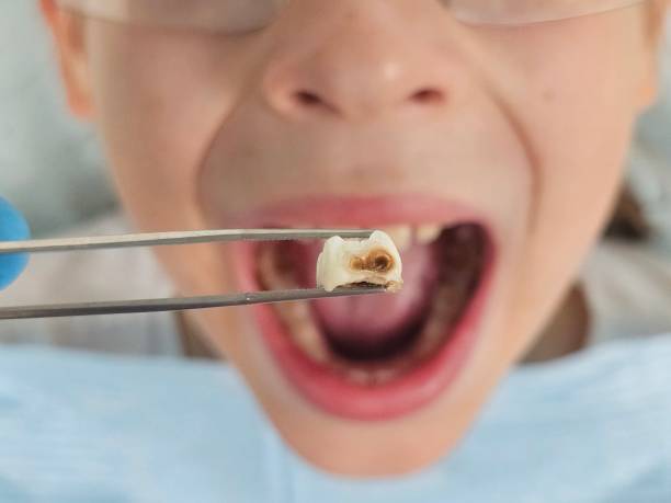 Best Emergency Dental Care for Abscessed Tooth in Walhalla, SC